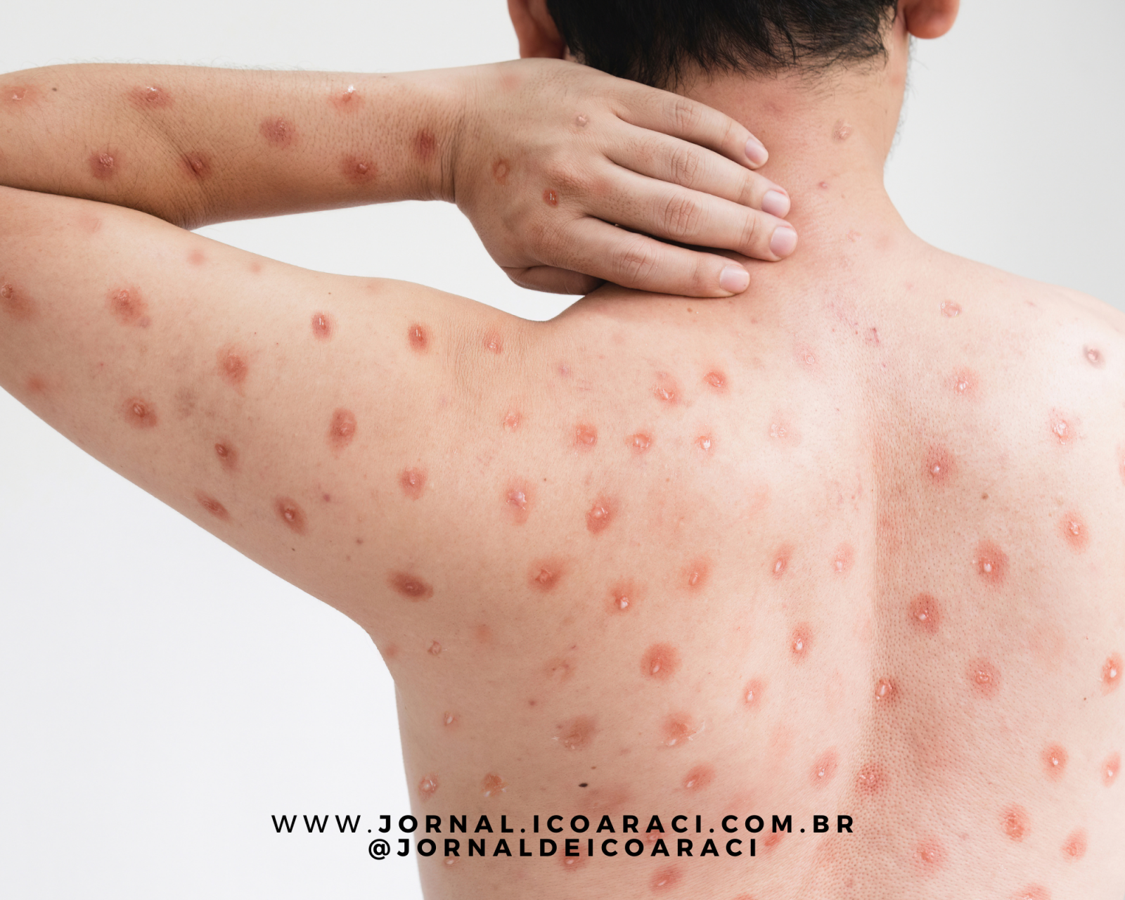 Pará Registra 19 Casos de Mpox em 2025: Sem Surto, Diz Sespa
